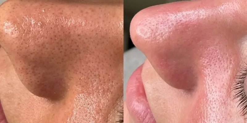 Limpieza facial profunda