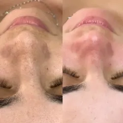 Limpieza facial profunda