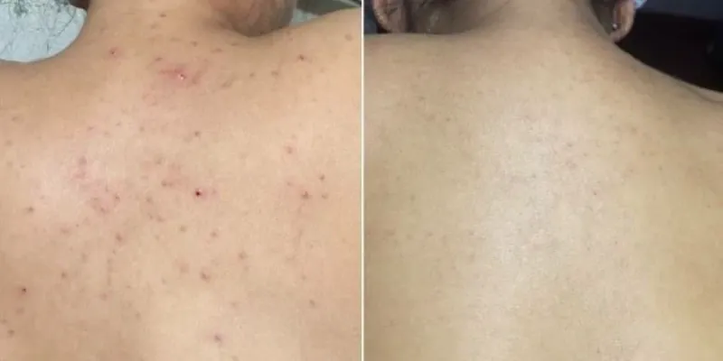 Limpieza profunda de espalda