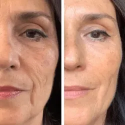 Plasma Rico en plaquetas (PRP)