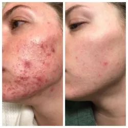 Tratamiento Antiacne