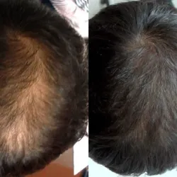 Tratamiento de la Alopecia 14usd cada sesion