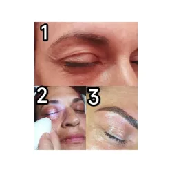 Fibroblast contornos ojos, labios, cuello o manos (precio por zona a tratar)