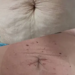 Fibroblast para estrías blancas