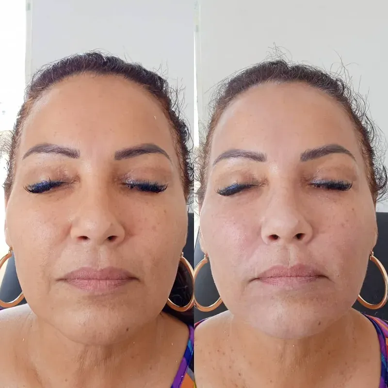 PRP (plasma rico en plaquetas)
