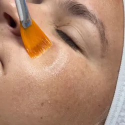 Peeling Químico
