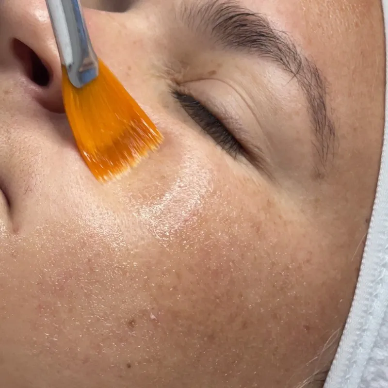 Peeling Químico