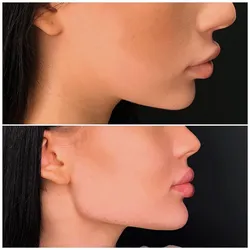 Definición Mandibular
