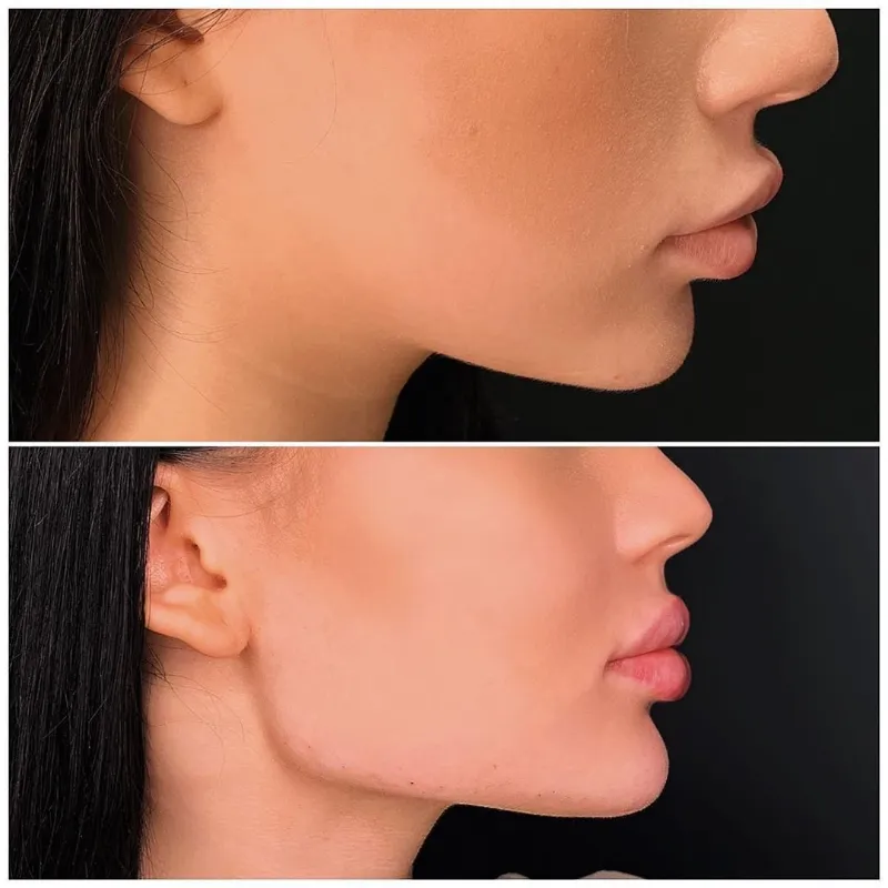 Definición Mandibular