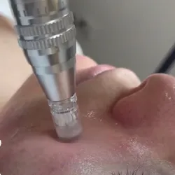 Microneedling + Hilo de Colágeno