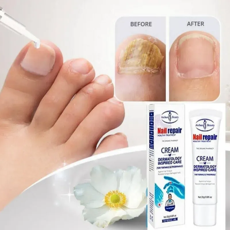 Crema Anti Hongos para las uñas 
