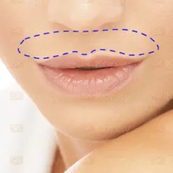 DEPILACIÓN LÁSER EN BIGOTE