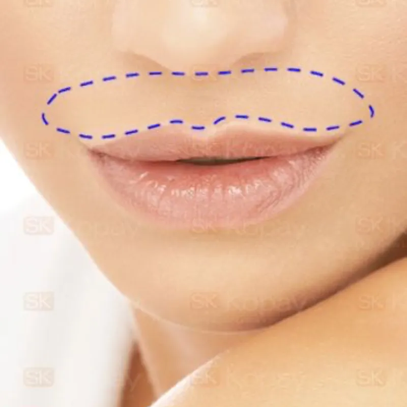 DEPILACIÓN LÁSER EN BIGOTE