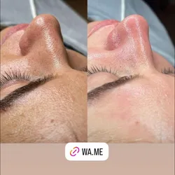 LIMPIEZA FACIAL /TRATAMIENTO FOTOTERAPIA /ALTA FRECUENCIA CAPILAR