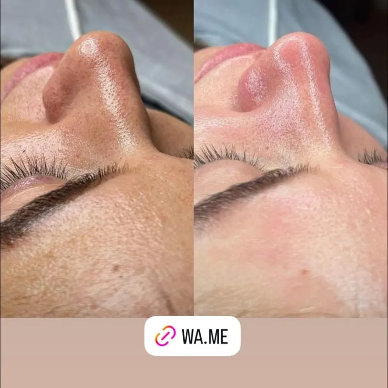 LIMPIEZA FACIAL /TRATAMIENTO FOTOTERAPIA /ALTA FRECUENCIA CAPILAR
