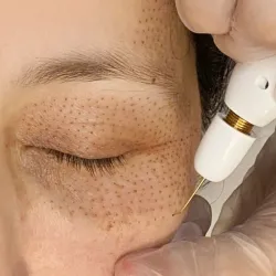 Tratamiento tensor con Fibroblast