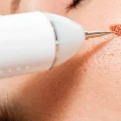 Eliminación de verrugas, lunares o pecas con Plasma Pen