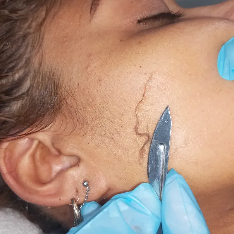 Tratamiento facial con dermaplaning.