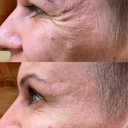 Botox en patas de gallo 