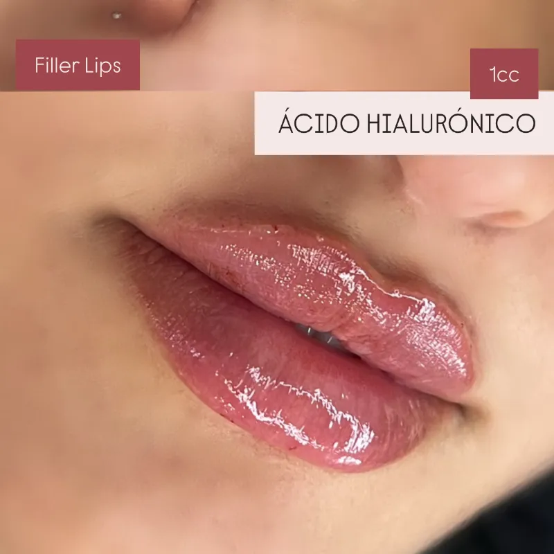 Relleno de Labios con Ácido Hialurónico 