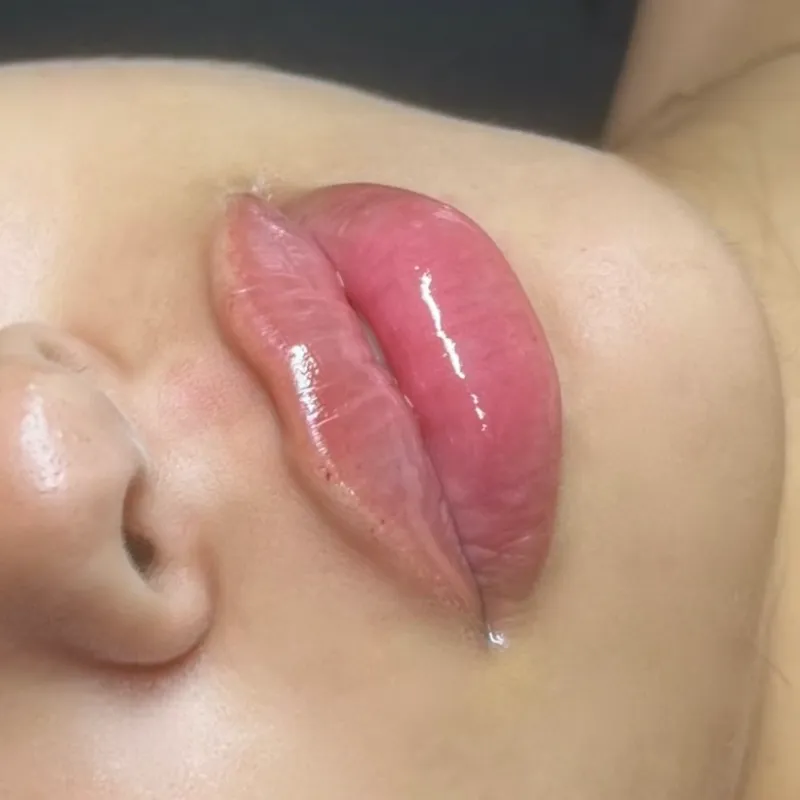 Relleno de Labios con Ácido Hialurónico 