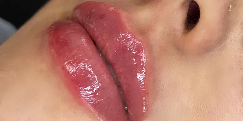 Relleno de Labios con Ácido Hialurónico 