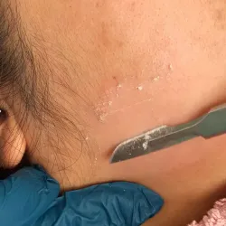 DERMAPLANING