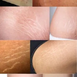 Tratamiento Antiestrias