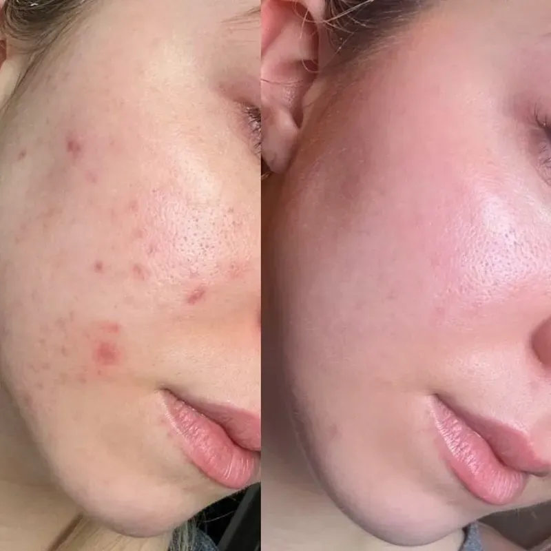TRATAMIENTO PEELING (ACNÉ)
