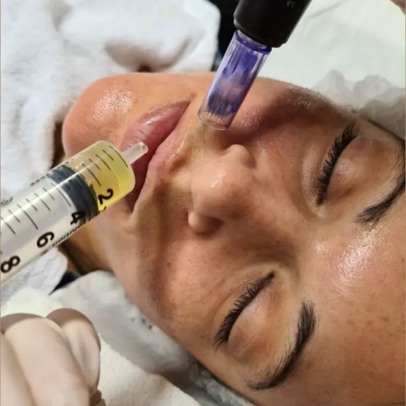 Tratamiento con Microneedling antimanchas antiacné antiedad 